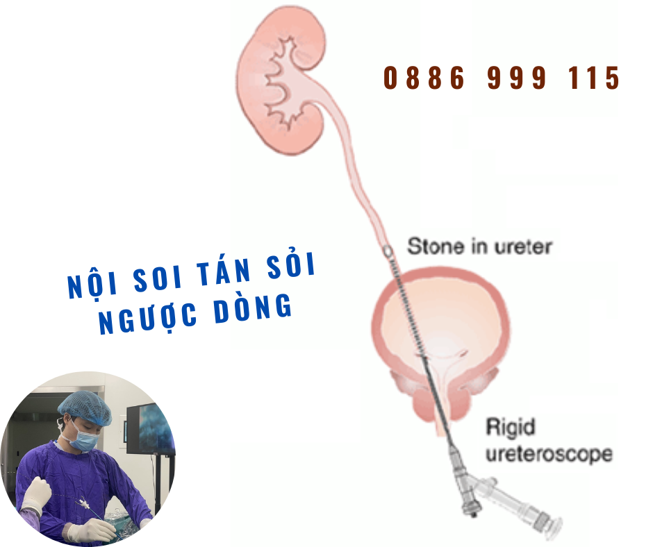 Phương pháp nội soi tán sỏi ngược dòng