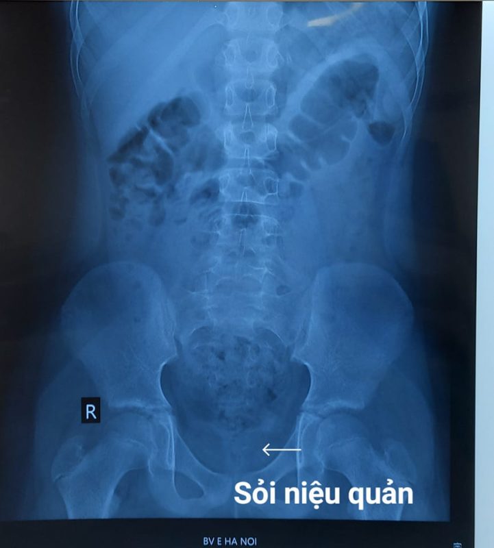 Hình ảnh sỏi niệu quản 1/3 dưới