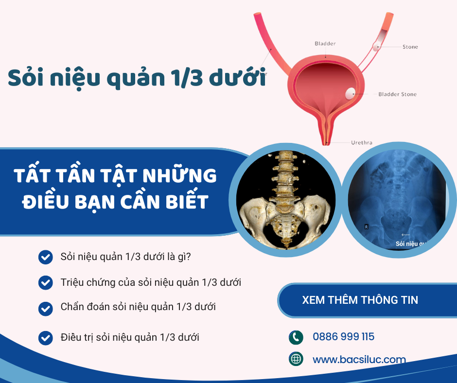 Sỏi niệu quản 1/3 dưới tất tần tật những điều bạn cần biết