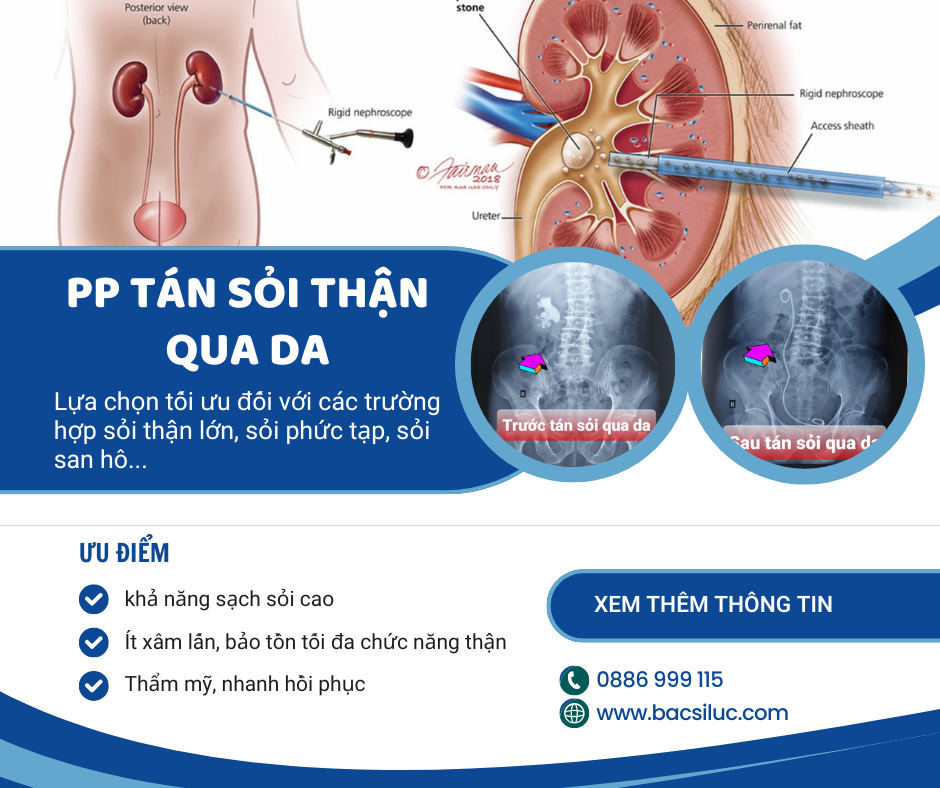 Phương pháp tán sỏi thận qua da