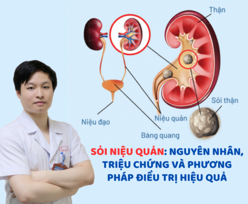 Sỏi niệu quản: Nguyên nhân, triệu chứng và phương pháp điều trị hiệu quản