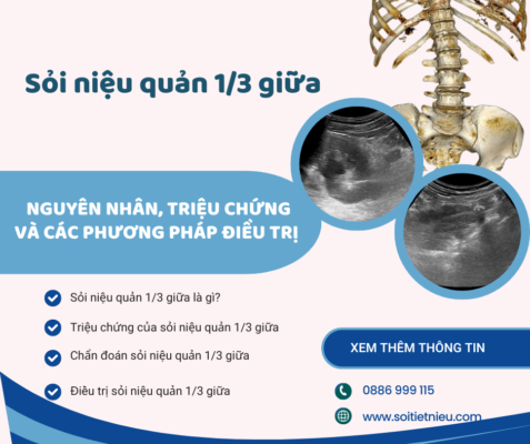 Sỏi niệu quản 1-3 giữa