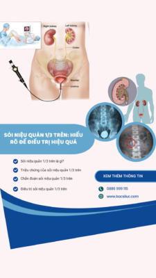 Sỏi niệu quản 1/3 trên là gì?